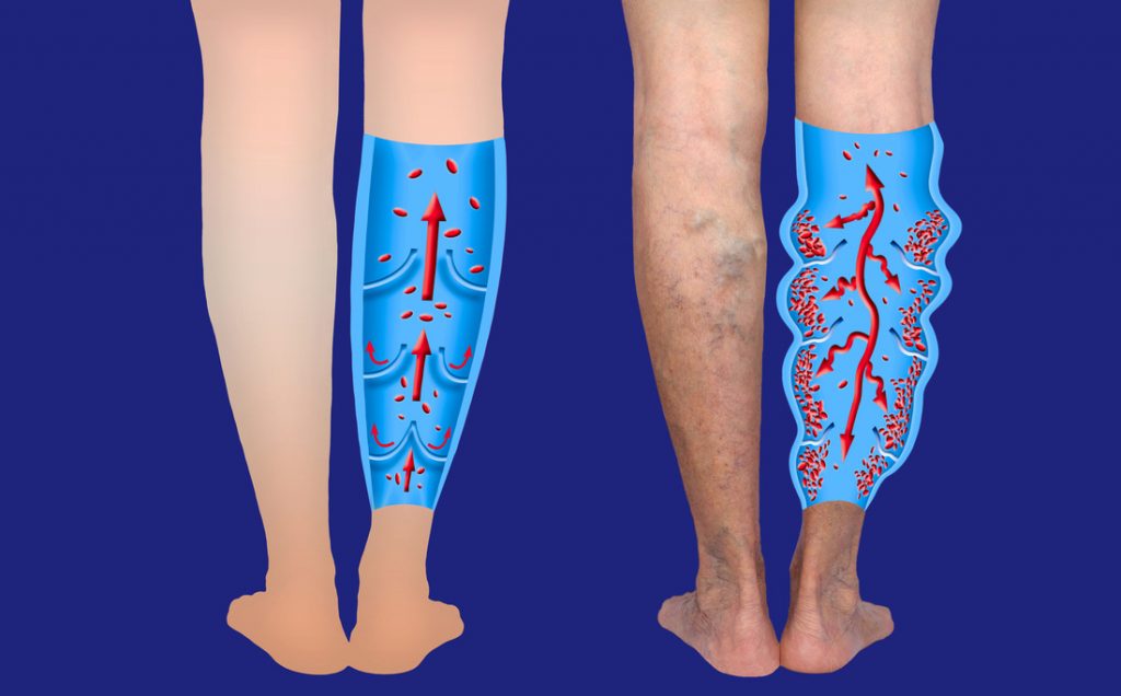 Tinea Versicolor On Legwomen's Compression Tights - Varicose Vein Support  & Leg Shaping