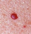 Hemangioma