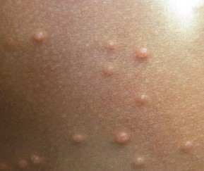 Molluscum Contagiosum