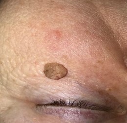 Sebhorrheic Keratosis